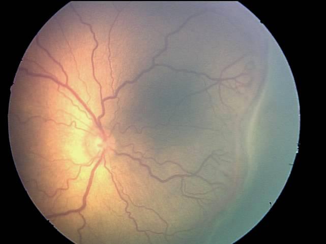 Retinopathy of Prematurity