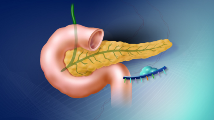 Large-scale genetic analysis shows microRNAs in human pancreas associated with diabetes