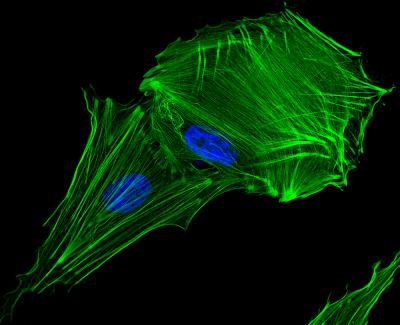 Neuroblastoma Cell Before Treatment