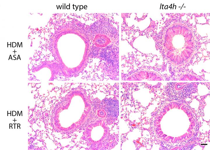 Fragments of a Support Structure Drive Airway Abnormalities in Asthma
