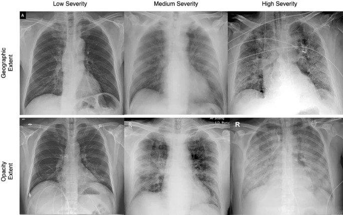 Chest x-rays