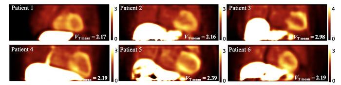 VT images for six patients generated from 30 minutes of dynamic data.