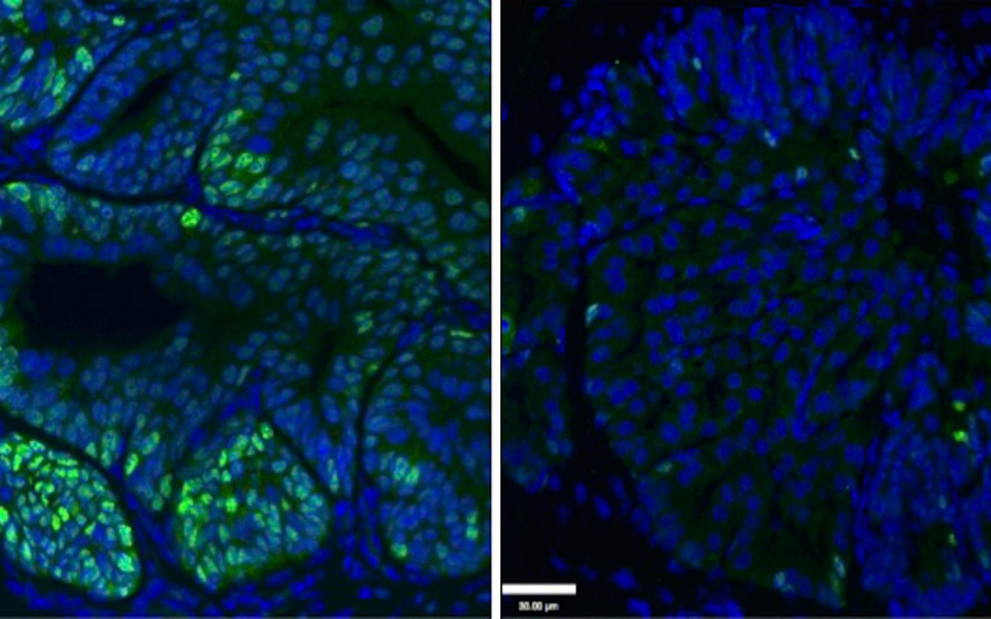 Getting Prostate Cancer Cells to Eat Themselves to Death