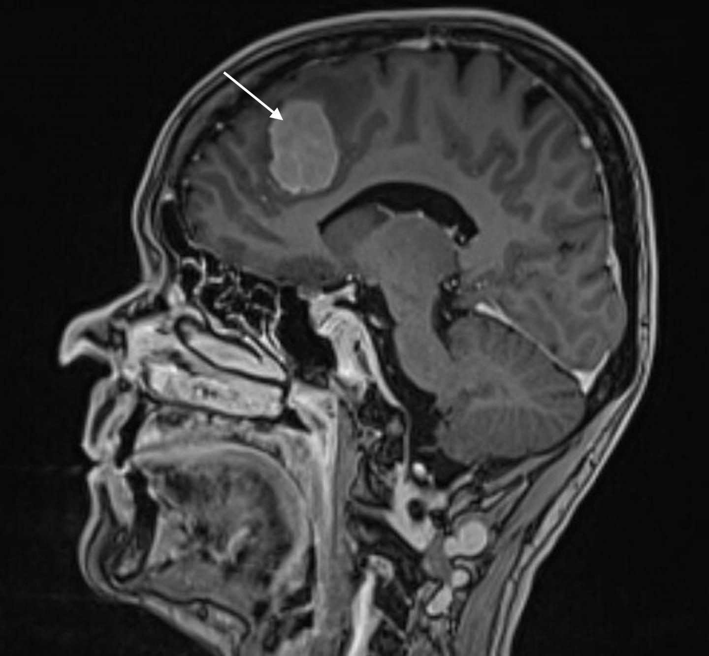 Magnetic Image of Meningioma