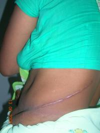 Kidney Scar on Woman