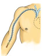 PICC Line