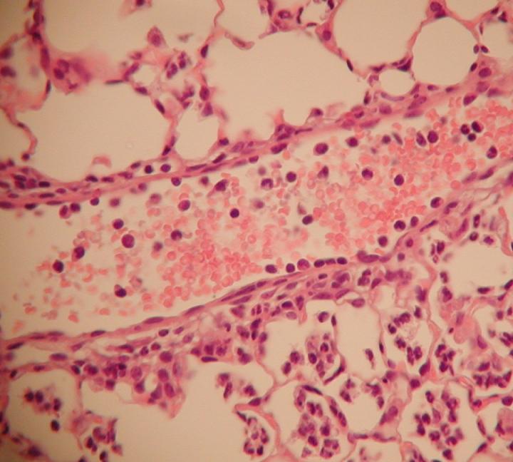 Discovery May Help Patients Beat Deadly Bacterial Pneumonia (2 of 2)