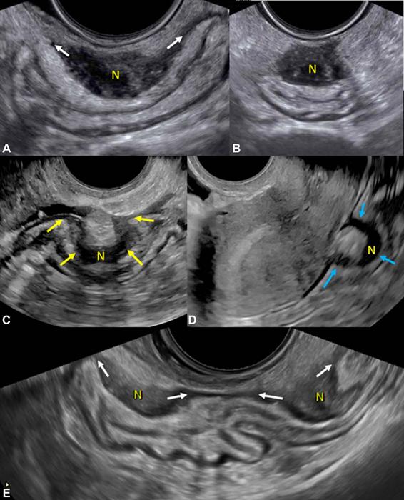 Transvaginal US shows deep endometriosis nodules in the rectosigmoid colon.