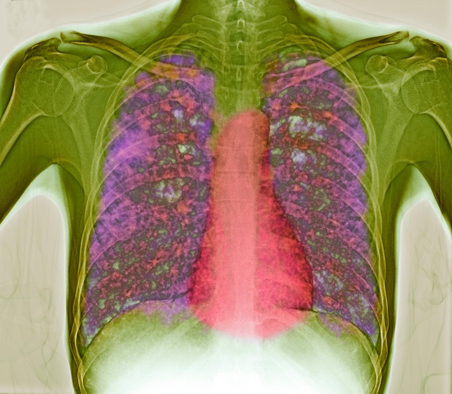 Disease Tolerance in Tuberculosis