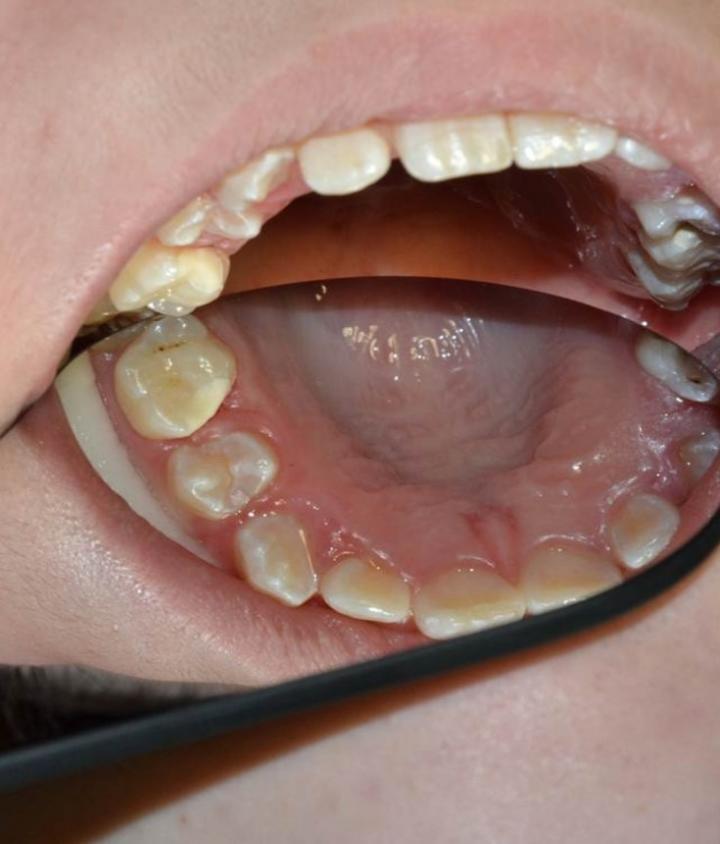 Image of Glass Cement Fillings