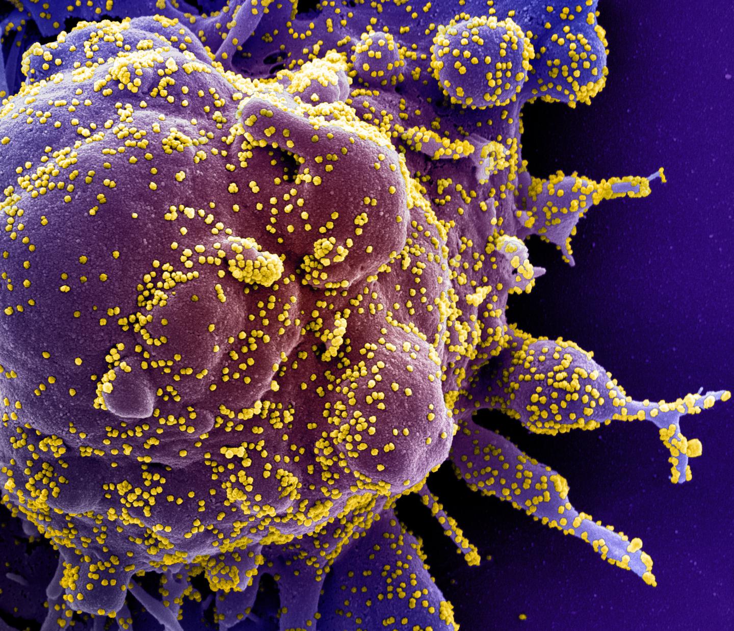 Colorized scanning electron micrograph of an apoptotic cell (purple) heavily infected with SARS-COV-2 virus particles (yellow)