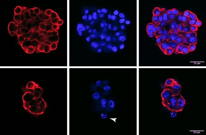 MicroRNAs Control Invasive Transition in Non-Small Cell Lung Cancer (1 of 2)