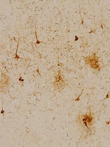 Frontal cortex from a patient with Alzheimer's disease