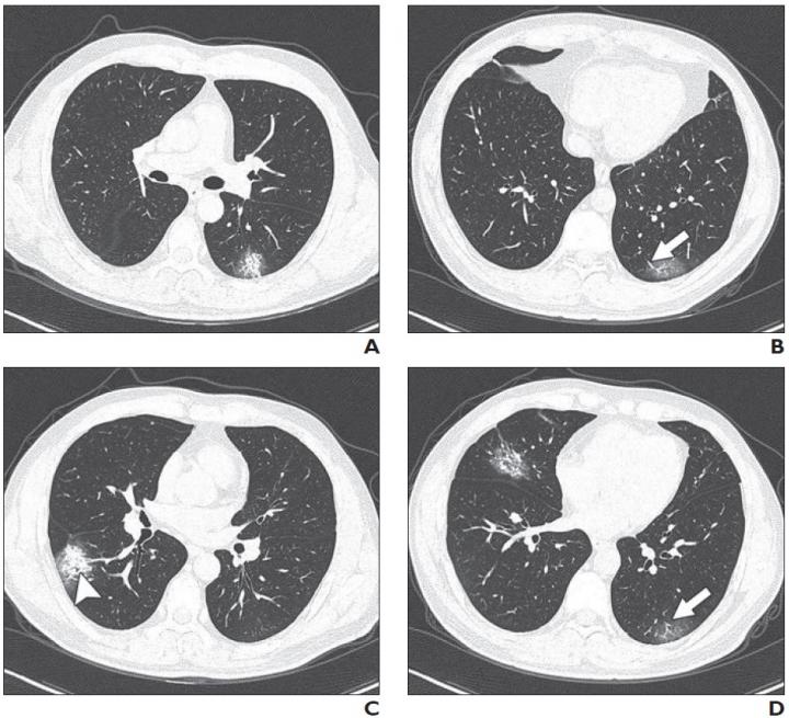 37-Year-Old Man with Confirmed Coronavirus Disease (COVID-19), Common Type