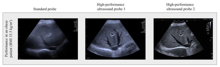 Scan of the liver of an obese patient