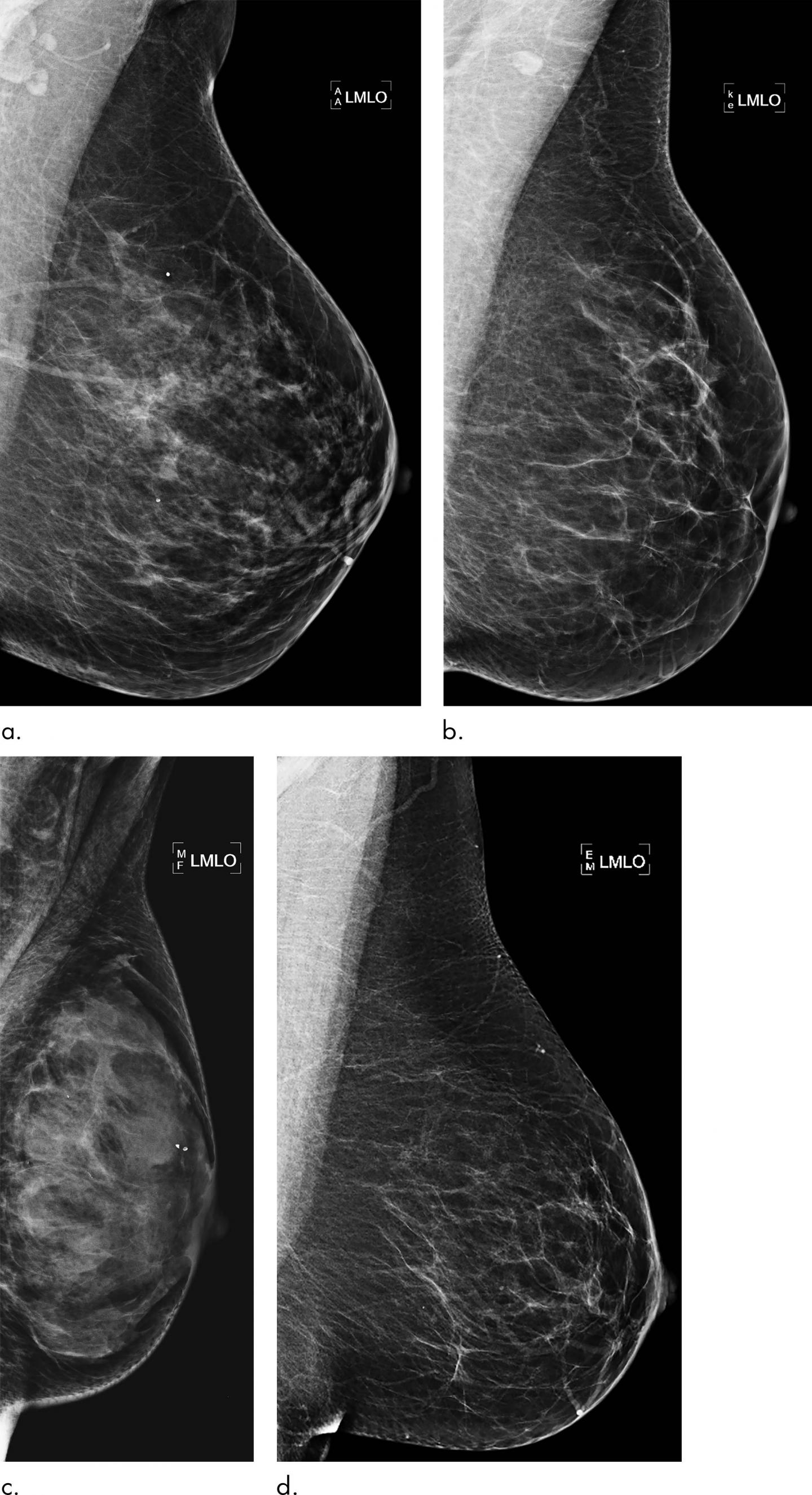 AI Improves Breast Cancer Risk Prediction