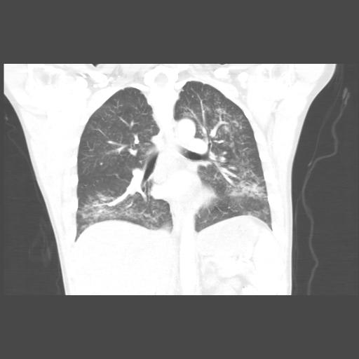 Physicians Create Guide for Identifying, Treating Vaping Lung Illness