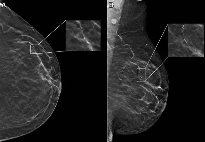 Example mammogram assigned a f [IMAGE] | EurekAlert! Science News Releases