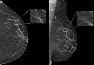 Example mammogram assigned a false-positive case score.