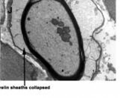 Collapsed Myelin Sheaths