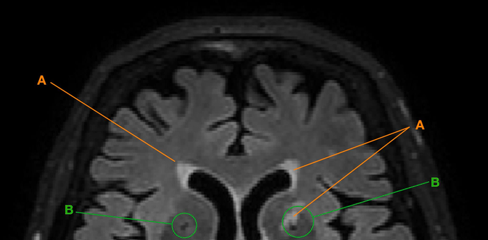 Brain MRI