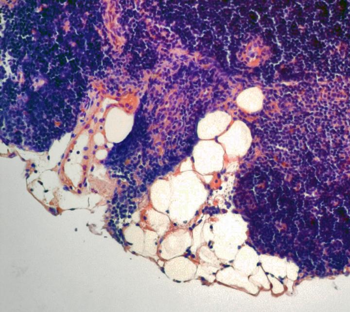 Aging Thymus with Fatty Degeneration