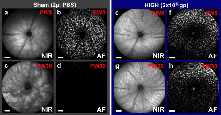 Retinal Degeneration