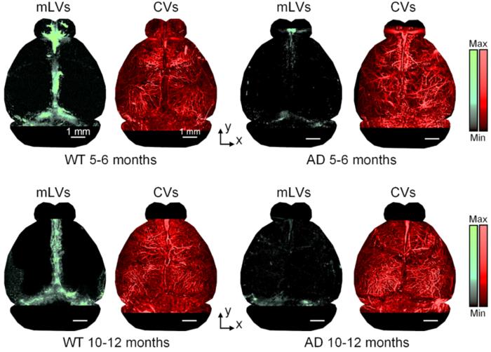 Figure 3 | The function of the meningeal lymphatic vessels in mice with Alzheimer’s disease is impaired.