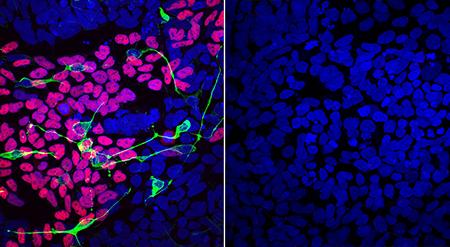 Differentiated Patient Cells Lack Markers of Normal Development