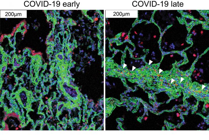 Immune cells (red) migrate near the cells that cause fibrosis (green) in late COVID-19.