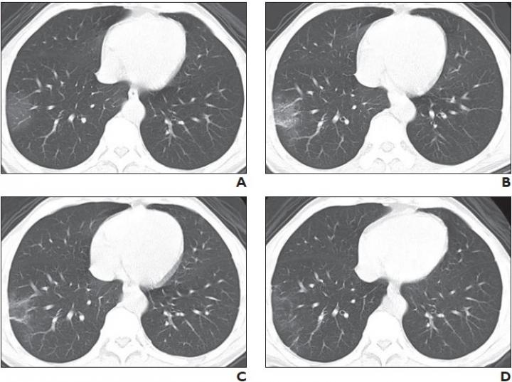 53-Year-Old Man with Coronavirus Disease Pneumonia