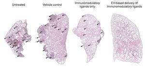 Tumour burden in lungs with advanced metastatic melanoma