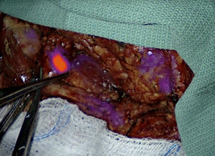 Glowing Lymph Node