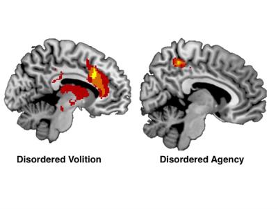 A Diagram Showing the Regions Associated with Disorders of Agency and Volition