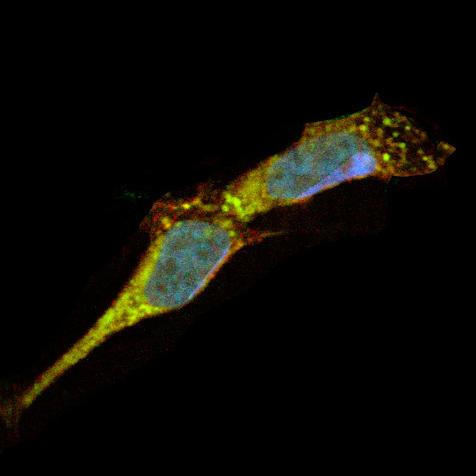 A Common Culprit in Parkinson's Disease?