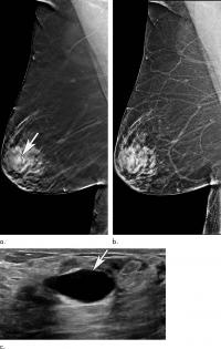 Older Women Benefit Significantly When Screened with 3-D Mammography