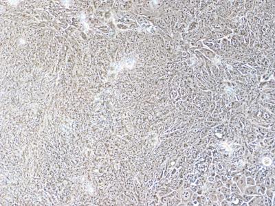 Untreated Cancer Keratonicytes