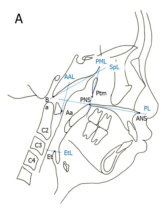 Figure 1.A Landmarks of the Nasopharynx, Oropharynx, and Hypopharynx
