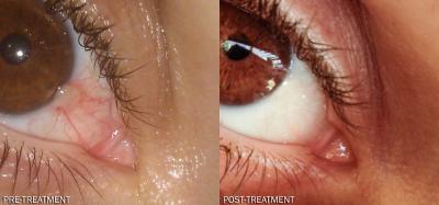 Pterygium Pre- and Post-treatment Photos Using Dipyridamole Eye Drops