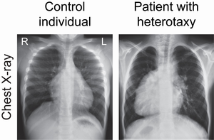 Scientists discover and name novel gene that governs left-right asymmetry within the human body