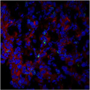 Immunofluorescence image of the expression of PHGDH (red) and CD3 T cells (green) in cryosectioned AE17 mesothelioma.