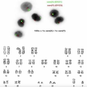 A case report of donor cell–derived hematologic neoplasms 9 years after allogeneic hematopoietic cell transplantation