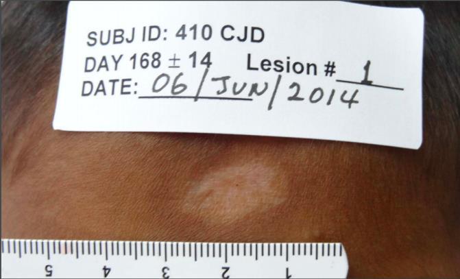 Topical Cream Found as Less-Toxic Therapy to Treat Cutaneous Leishmaniasis