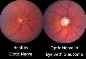 How Glaucoma Affects the Optic Nerve