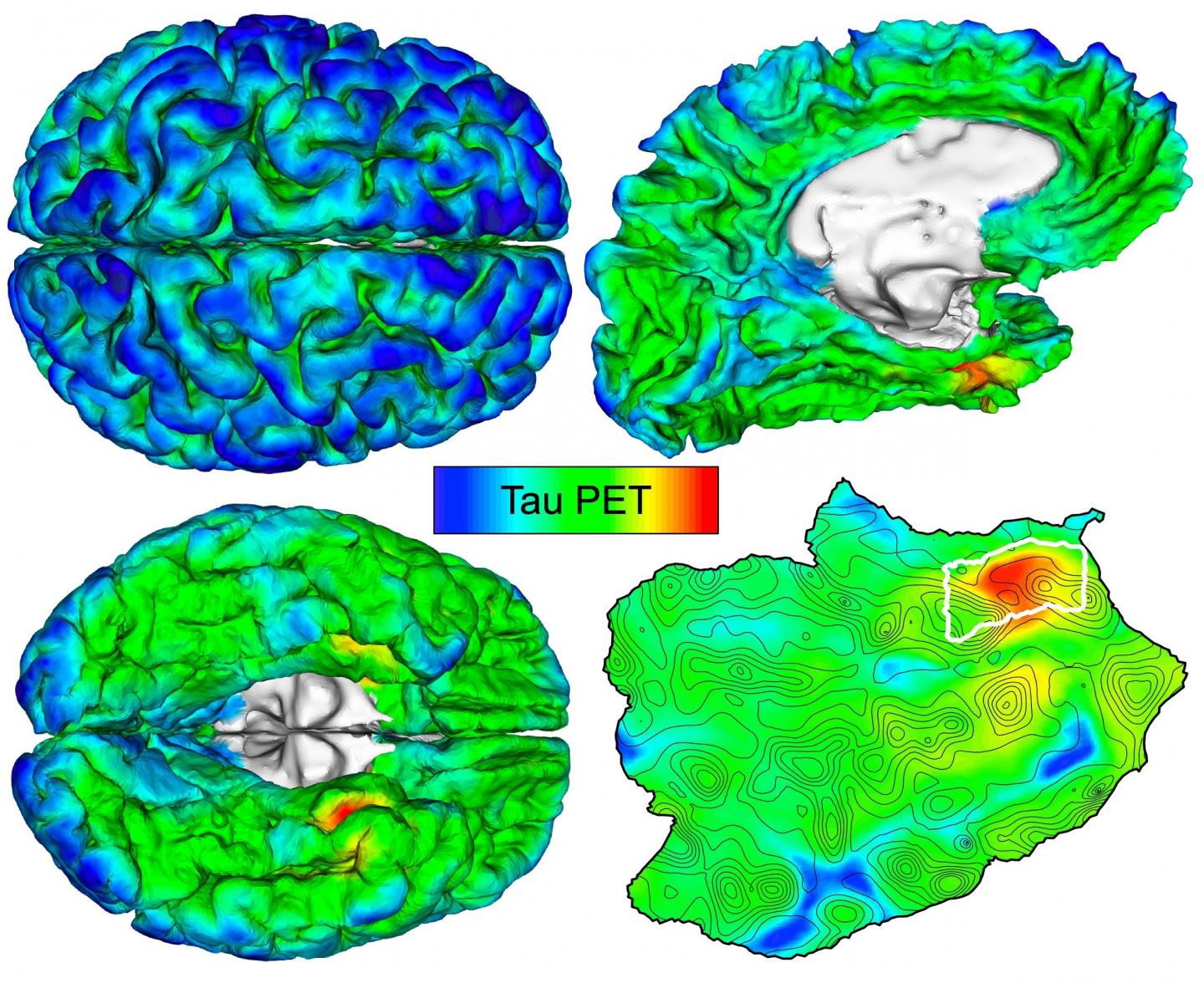 Automated imaging detects and tracks brain protein involved in Alzheimer's disease