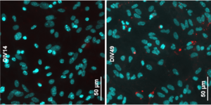 Discovery Illuminates How Parkinson’s Disease Spreads in The Brain