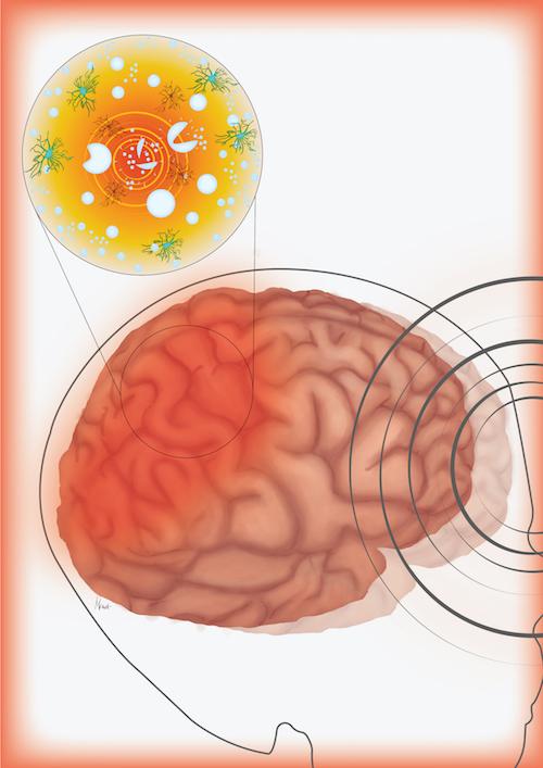 Bubbles Contribute to Brain Injuries