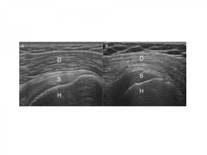 Images of the Shoulder Showing Reversal of the Rotator Cuff to Deltoid Gradient in Diabetic Patient