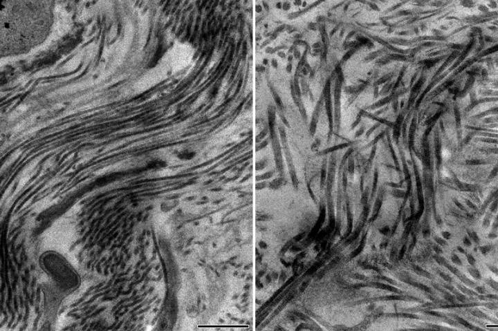 Healthy Scar with Collagen Type 5; Unhealthy Scar without Collagen Type 5