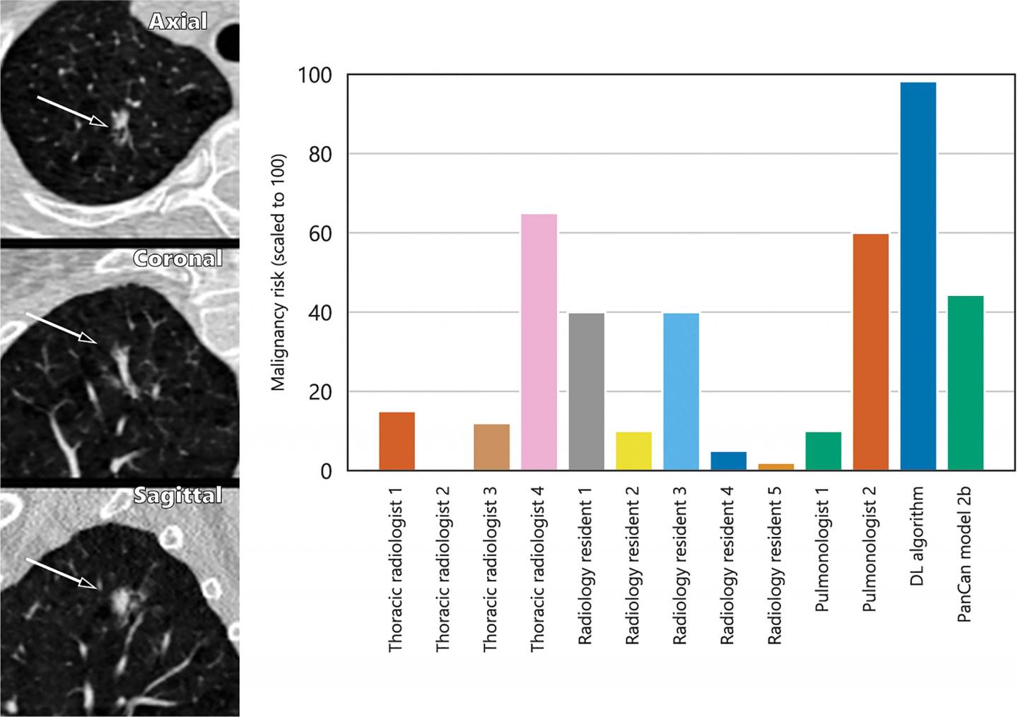 AI Predicts Lung Cancer Risk